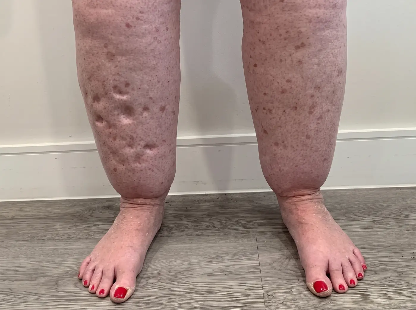 Photograph of lower legs showing nodules and skin changes